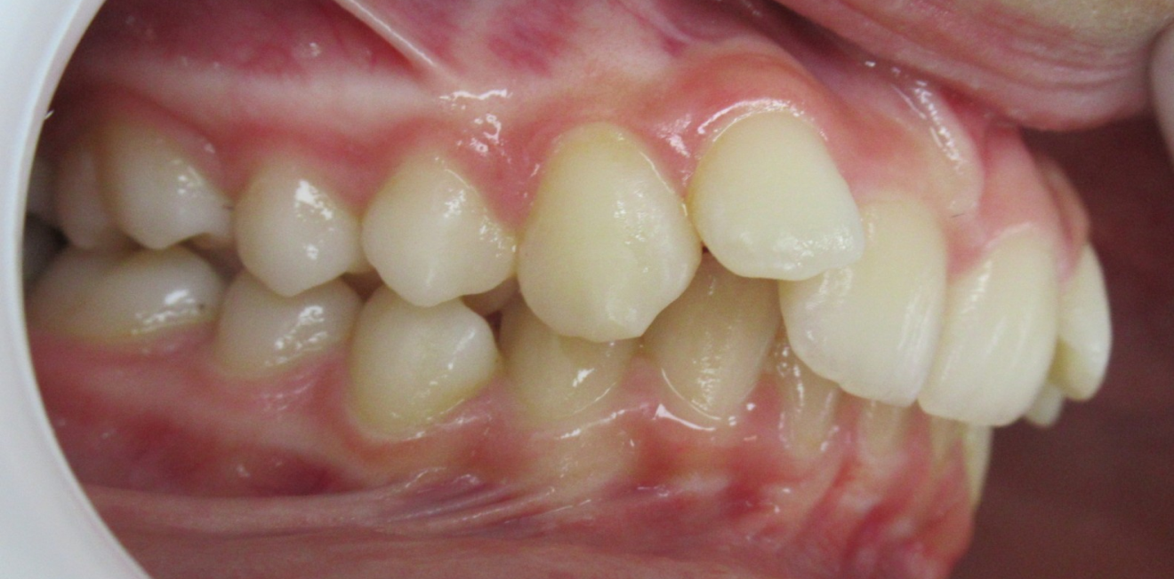 becchetti_bagues_3_1