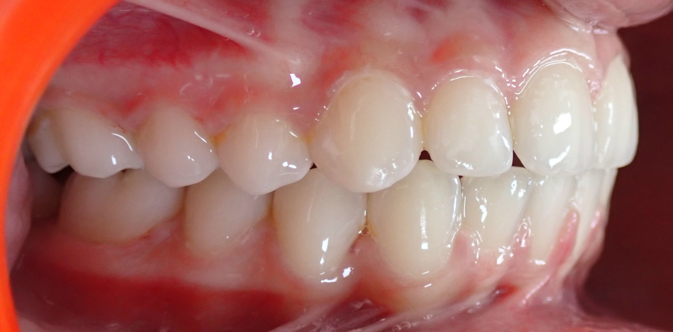 becchetti_bagues_4_1