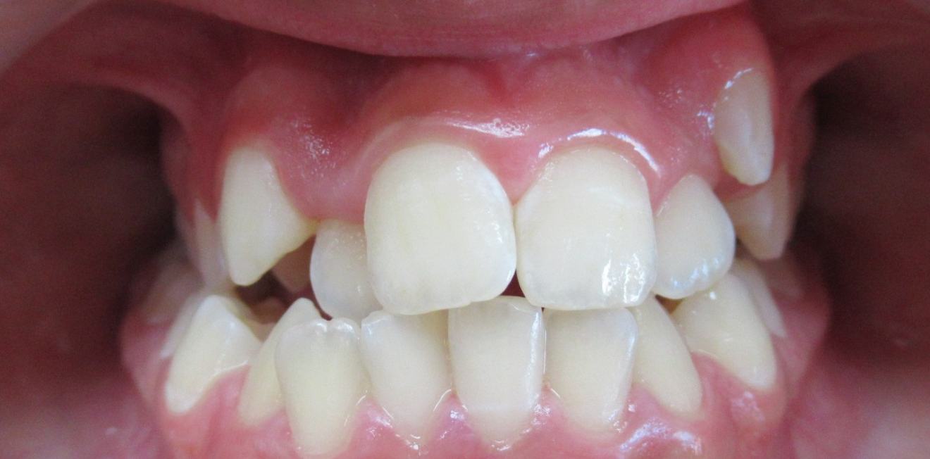 el_khattari_disjoncetur_bagues_5_1_1