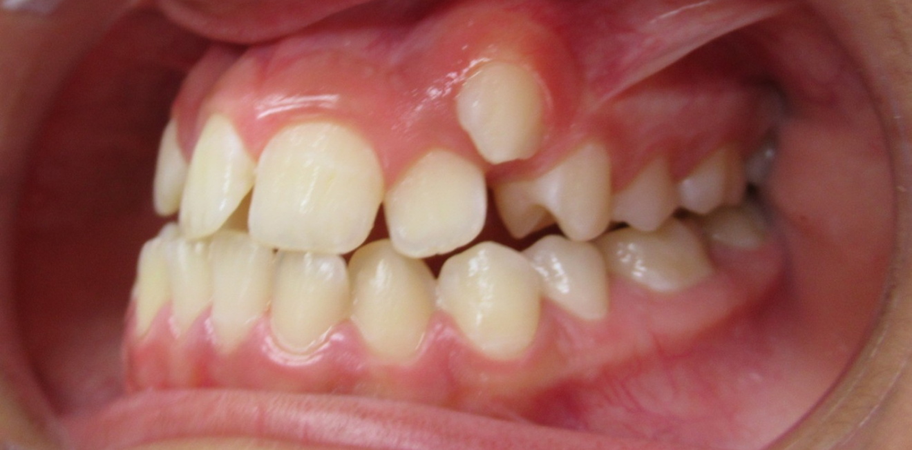 el_khattari_disjoncetur_bagues_7_1_1