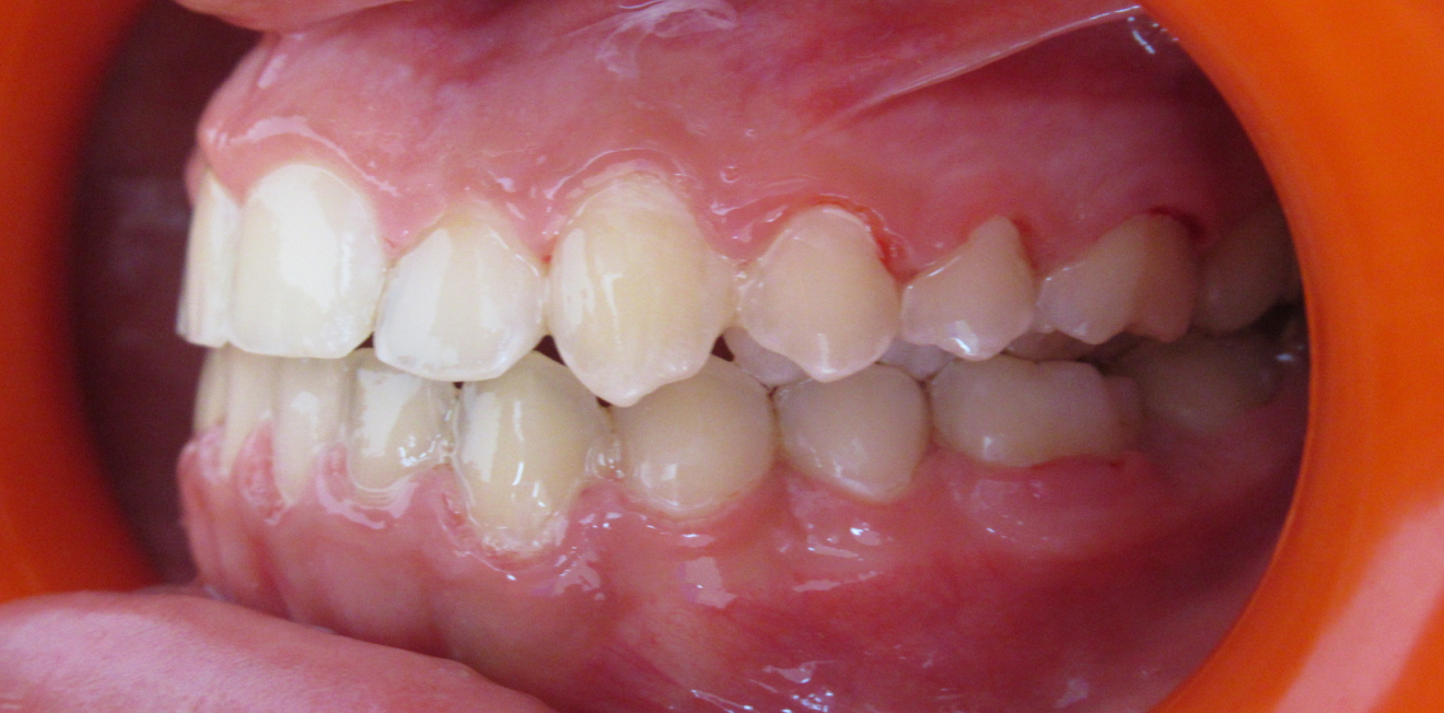 el_khattari_disjoncetur_bagues_8_1_1