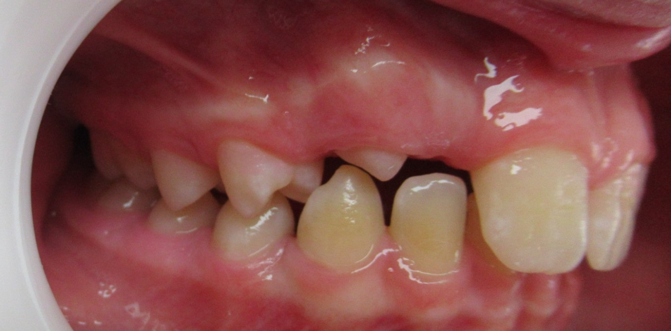 fagnard_agenesie_12_22_3_1