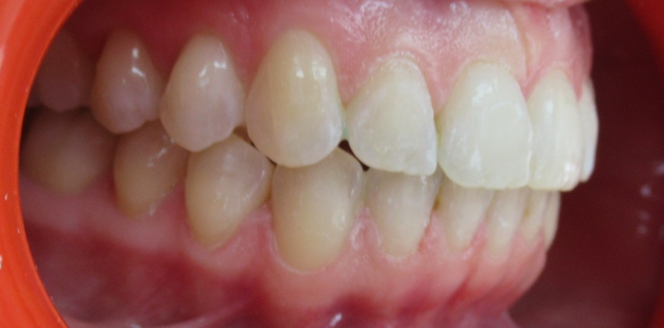 fillatre_gouttieres_4_1