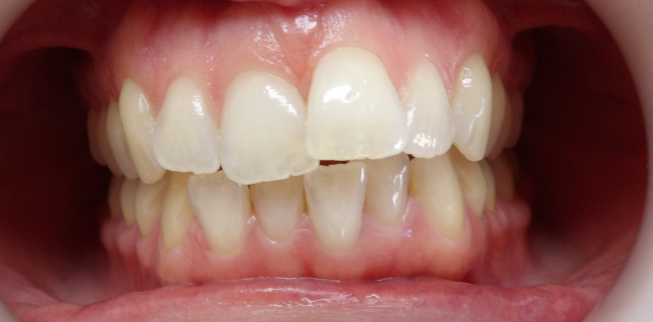 fillatre_gouttieres_5_1_1