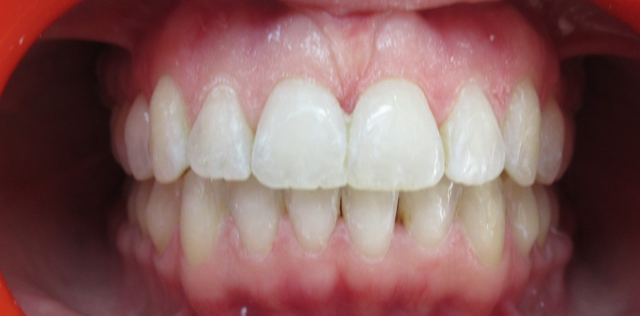 fillatre_gouttieres_6_1_1