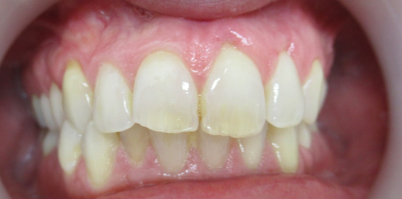 gerber_gouttieres_5_1