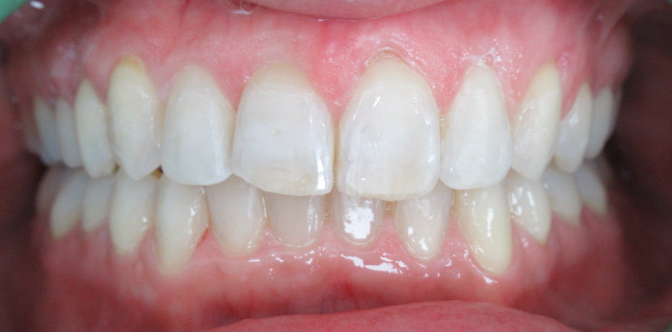 gerber_gouttieres_6_1