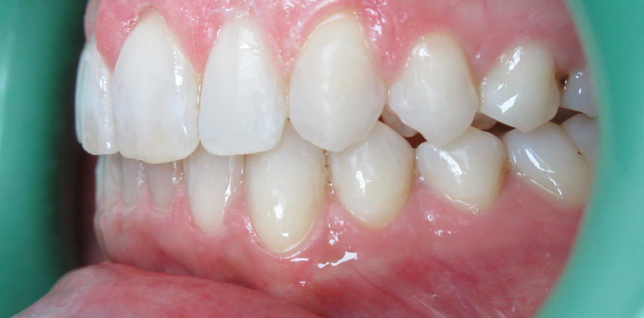 gerber_gouttieres_8_1