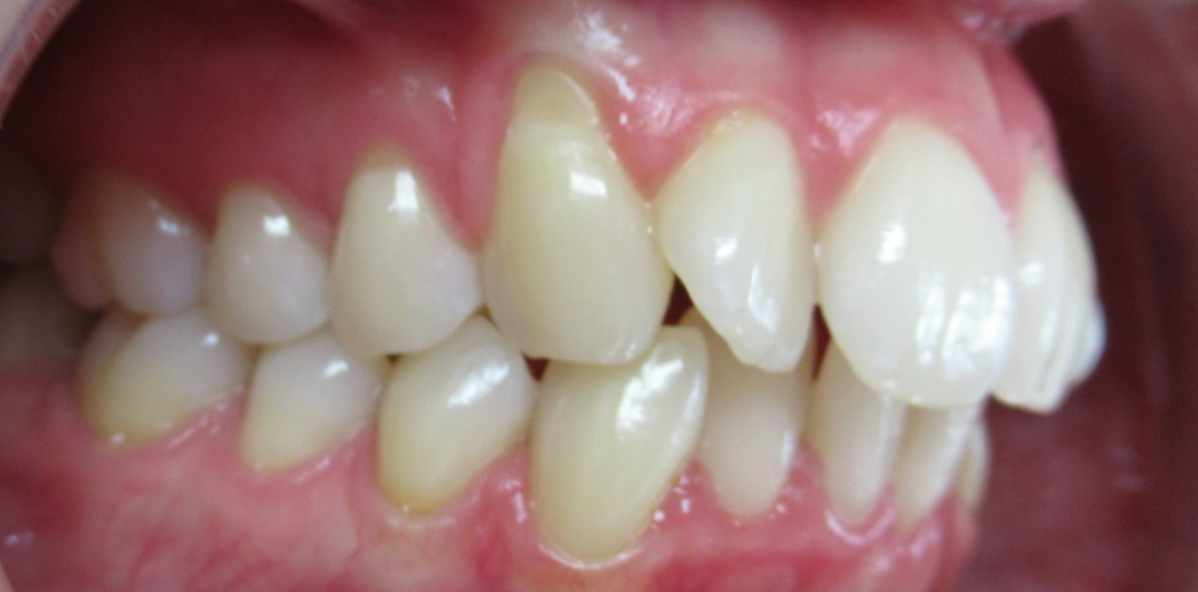 jaspart_gouttieres_2_1