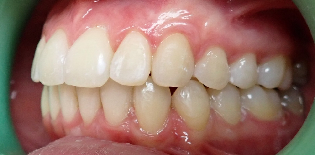 jaspart_gouttieres_7_1