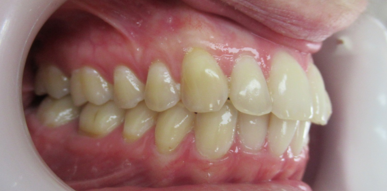 poujois_gouttieres_3_1