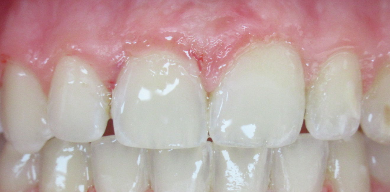 pulcinschi_bagues_6_1